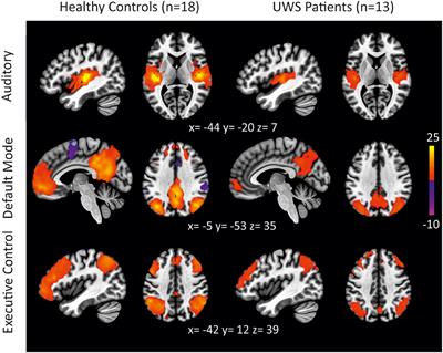 Auditory Stimulation Modulates Resting-State Functional Connectivity in Unresponsive Wakefulness Syndrome Patients